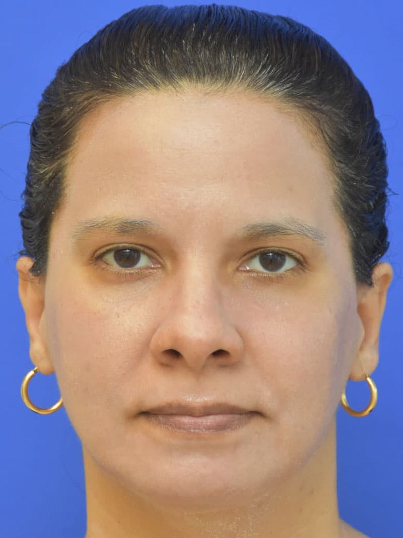 CO2 Before & After Gallery - Patient 366835 - Image 2