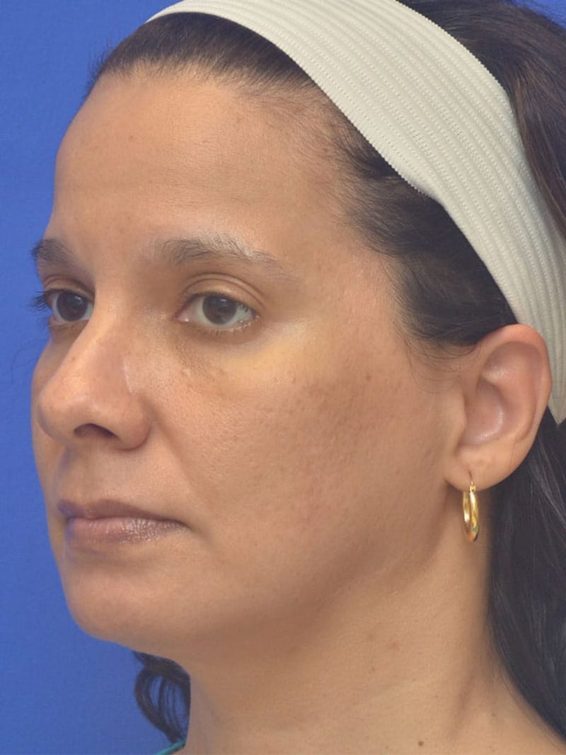 CO2 Before & After Gallery - Patient 366835 - Image 3