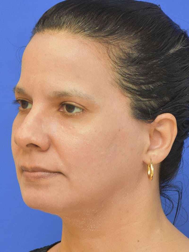 CO2 Before & After Gallery - Patient 366835 - Image 4
