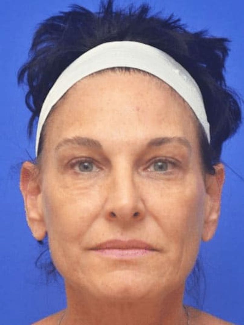 CO2 Before & After Gallery - Patient 320088 - Image 1