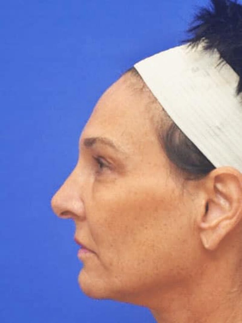 CO2 Before & After Gallery - Patient 320088 - Image 5
