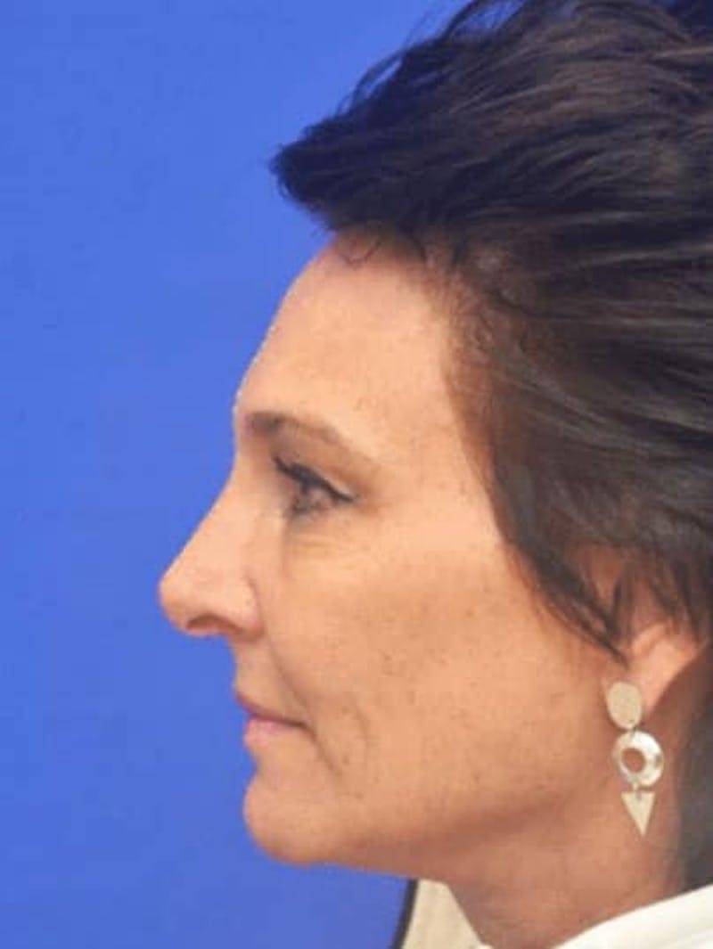 CO2 Before & After Gallery - Patient 320088 - Image 6