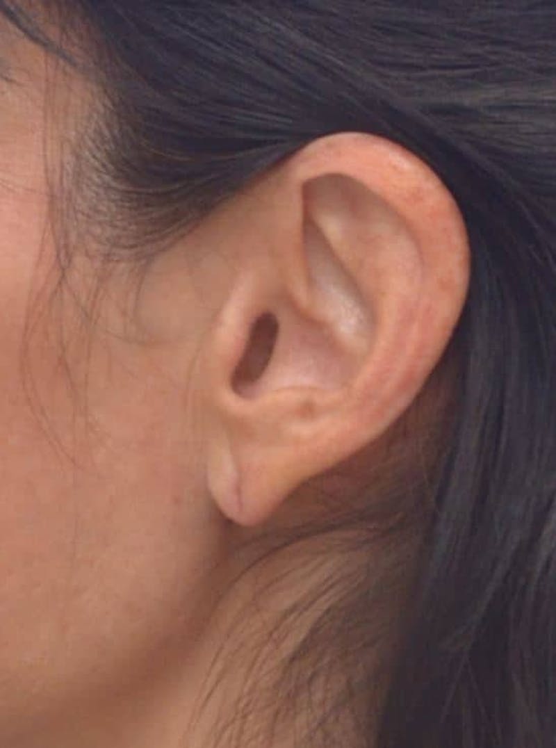 Earlobe Lift Before & After Gallery - Patient 152883 - Image 1