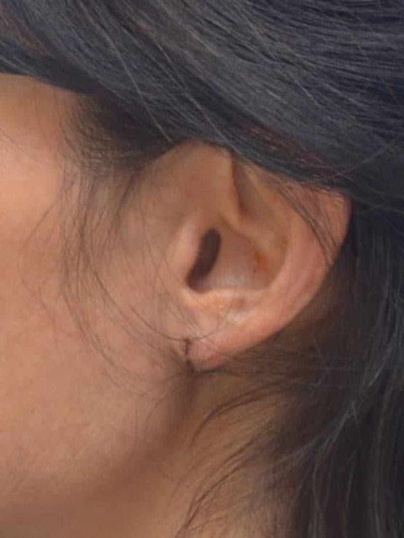 Earlobe Lift Before & After Gallery - Patient 152883 - Image 2