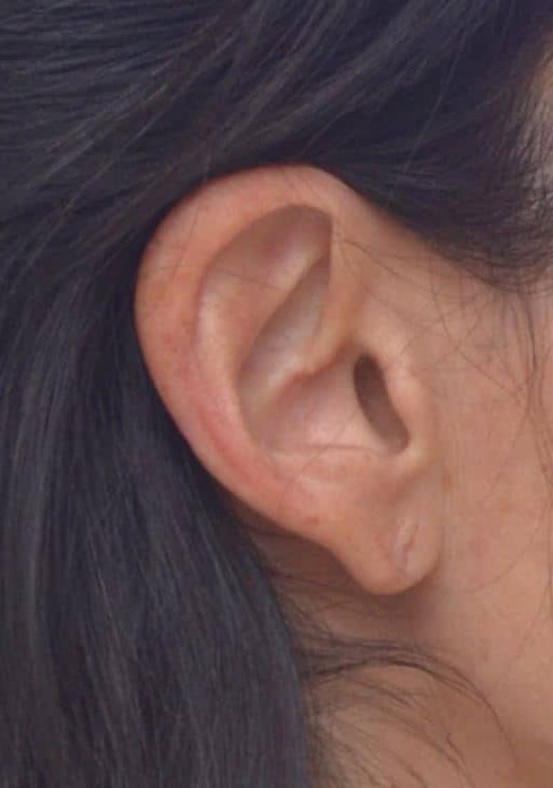 Earlobe Lift Before & After Gallery - Patient 152883 - Image 3