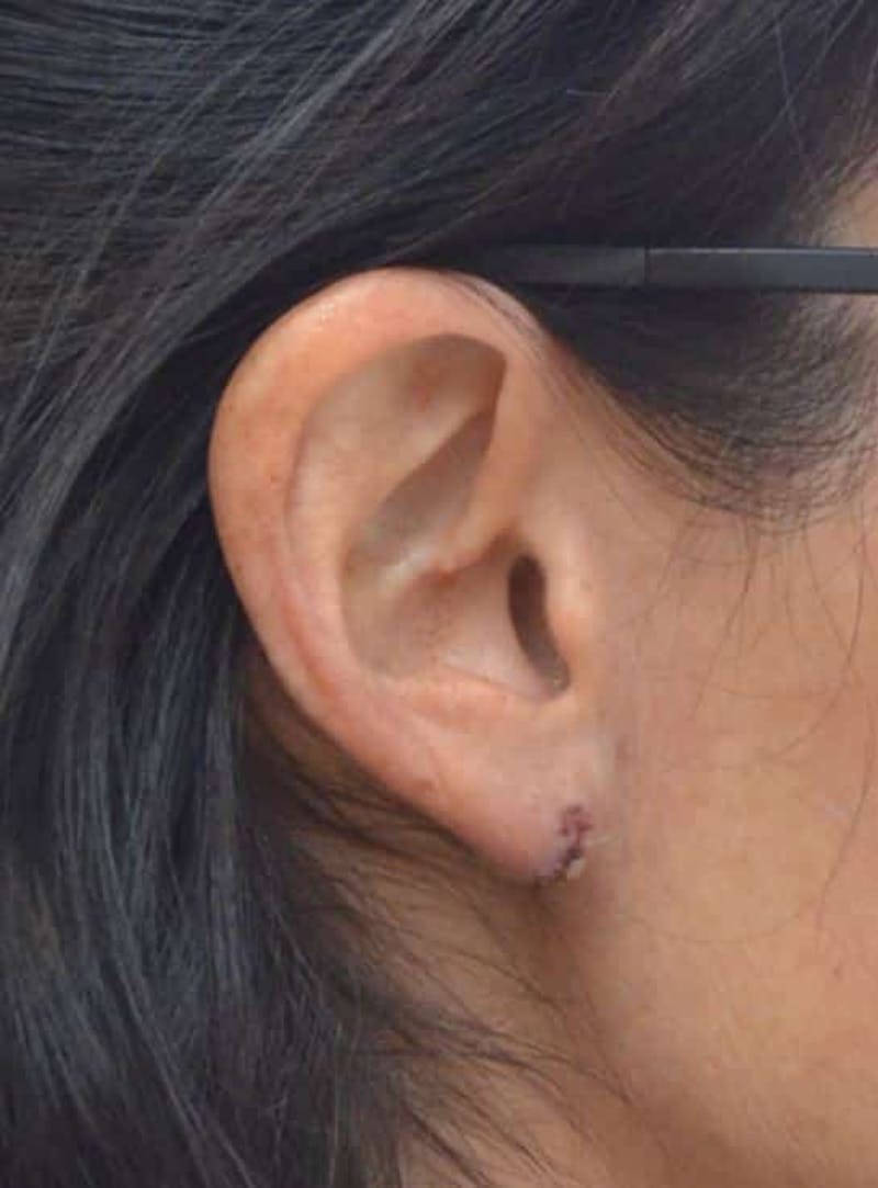 Earlobe Lift Before & After Gallery - Patient 152883 - Image 4