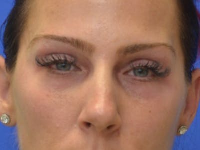Blepharoplasty Before & After Gallery - Patient 200326 - Image 1