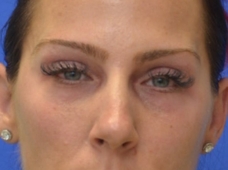 Blepharoplasty Before & After Gallery - Patient 200326 - Image 1