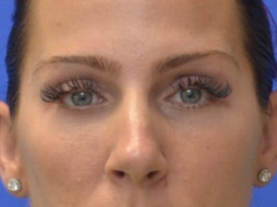 Blepharoplasty Before & After Gallery - Patient 200326 - Image 2
