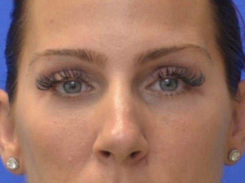 Blepharoplasty Before & After Gallery - Patient 200326 - Image 2