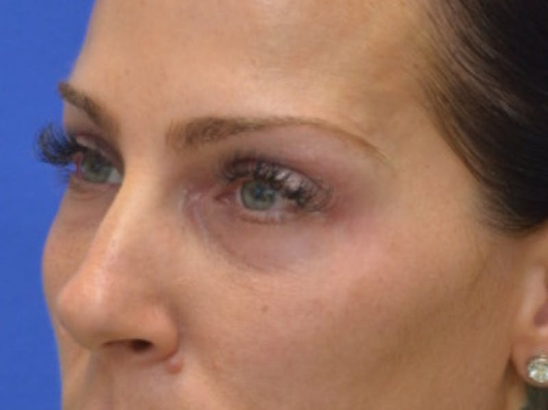 Blepharoplasty Before & After Gallery - Patient 200326 - Image 3