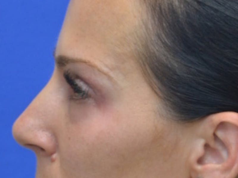 Blepharoplasty Before & After Gallery - Patient 200326 - Image 5