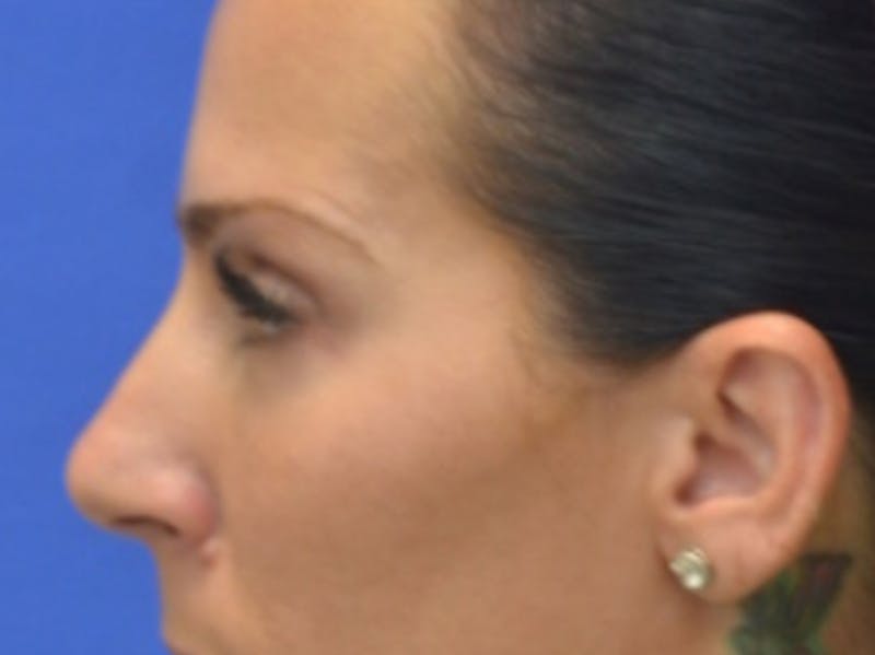 Blepharoplasty Before & After Gallery - Patient 200326 - Image 6