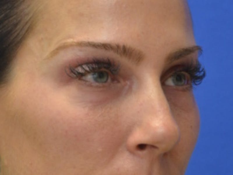 Blepharoplasty Before & After Gallery - Patient 200326 - Image 7
