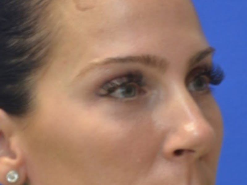 Blepharoplasty Before & After Gallery - Patient 200326 - Image 8