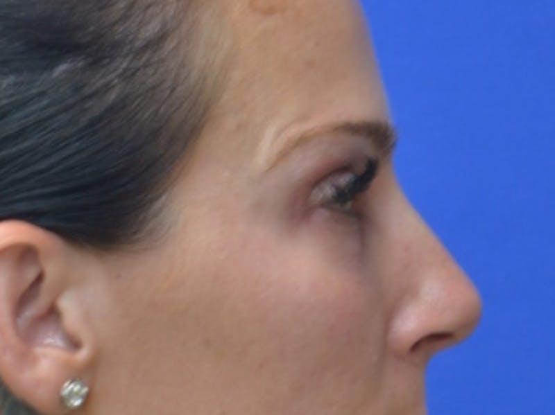Blepharoplasty Before & After Gallery - Patient 200326 - Image 9