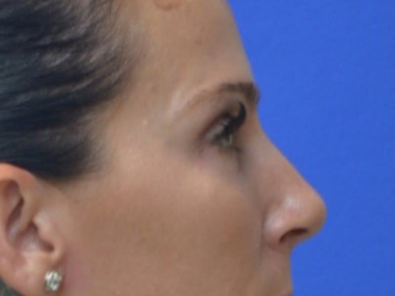 Blepharoplasty Before & After Gallery - Patient 200326 - Image 10