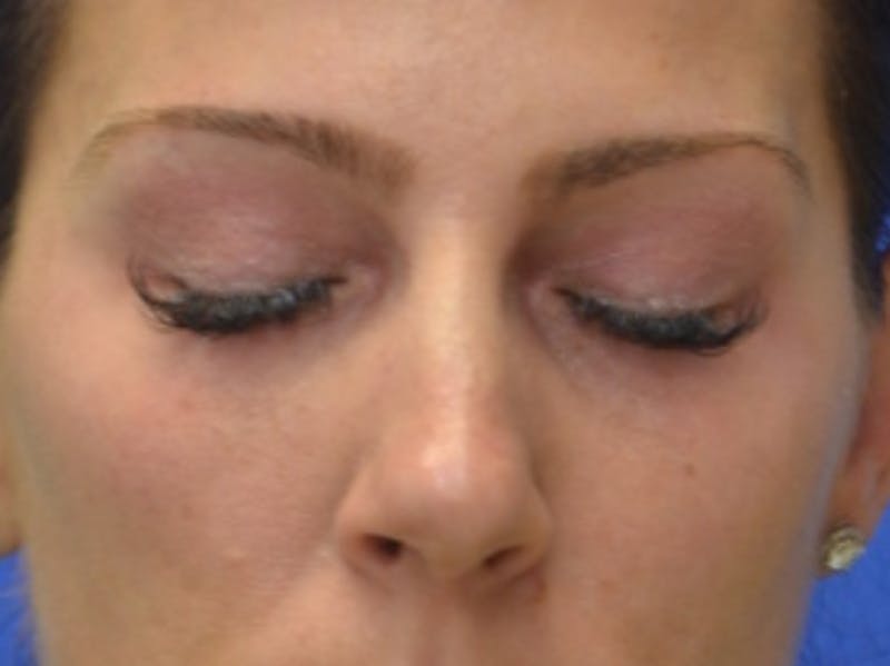 Blepharoplasty Before & After Gallery - Patient 200326 - Image 11