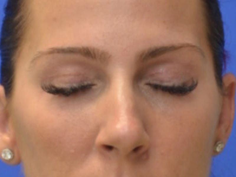 Blepharoplasty Before & After Gallery - Patient 200326 - Image 12