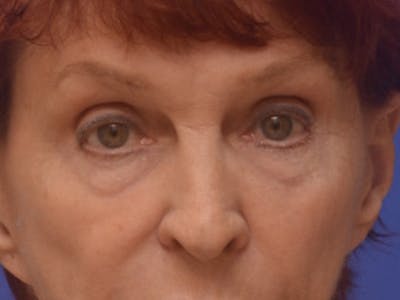 Blepharoplasty Before & After Gallery - Patient 178587 - Image 1
