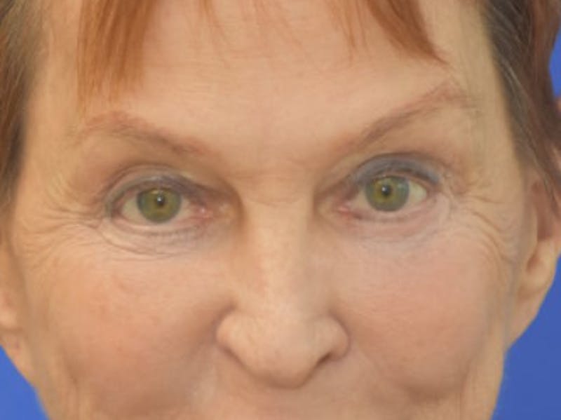 Blepharoplasty Before & After Gallery - Patient 178587 - Image 2