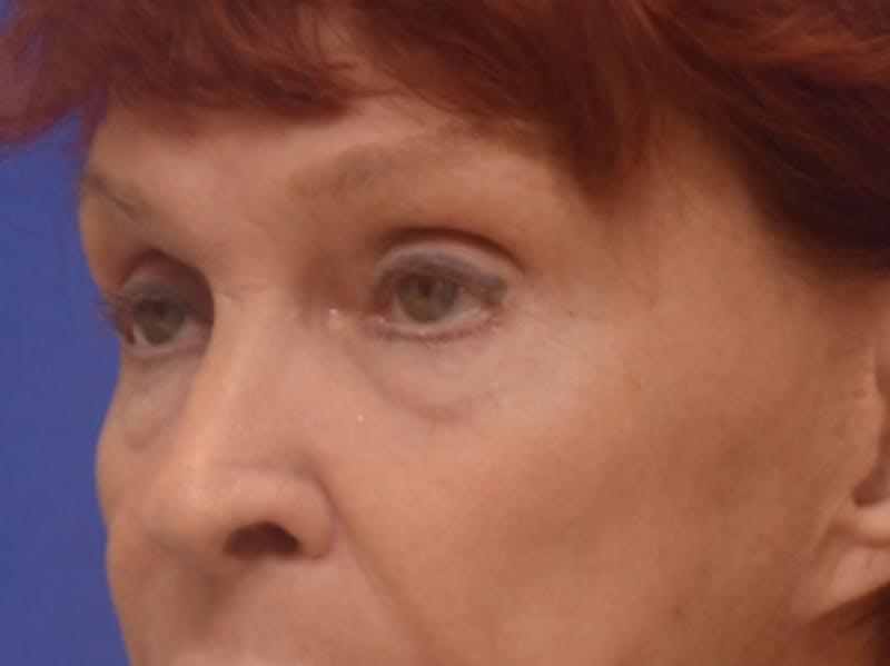 Blepharoplasty Before & After Gallery - Patient 178587 - Image 3