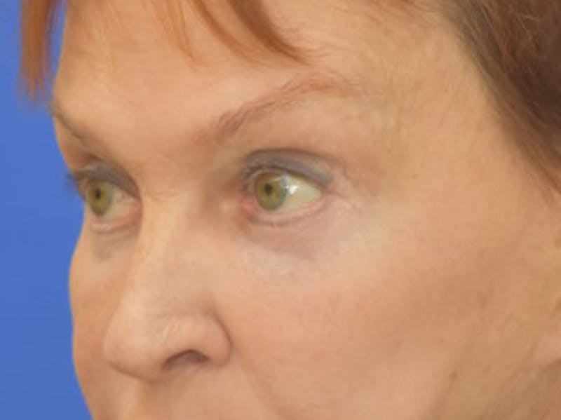 Blepharoplasty Before & After Gallery - Patient 178587 - Image 4