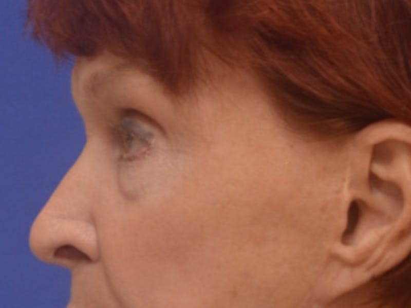 Blepharoplasty Before & After Gallery - Patient 178587 - Image 5