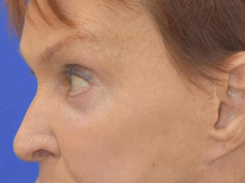 Blepharoplasty Before & After Gallery - Patient 178587 - Image 6