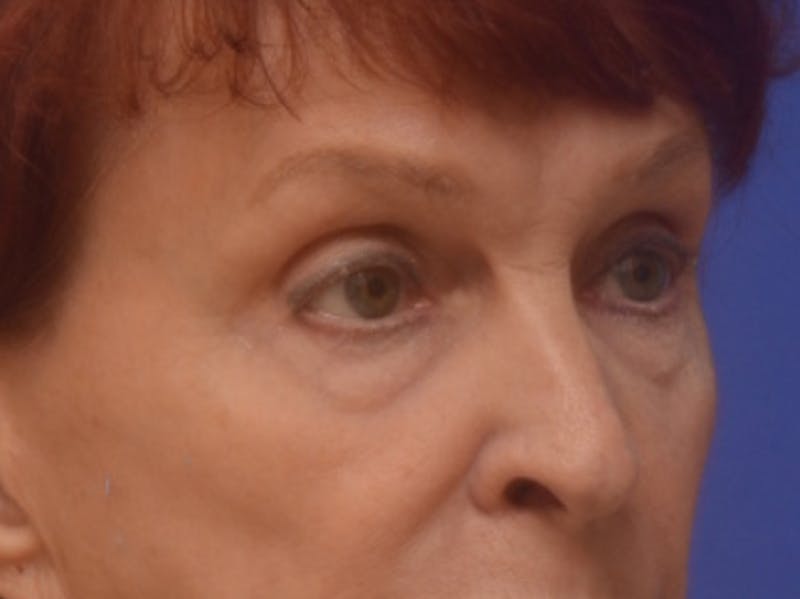 Blepharoplasty Before & After Gallery - Patient 178587 - Image 7