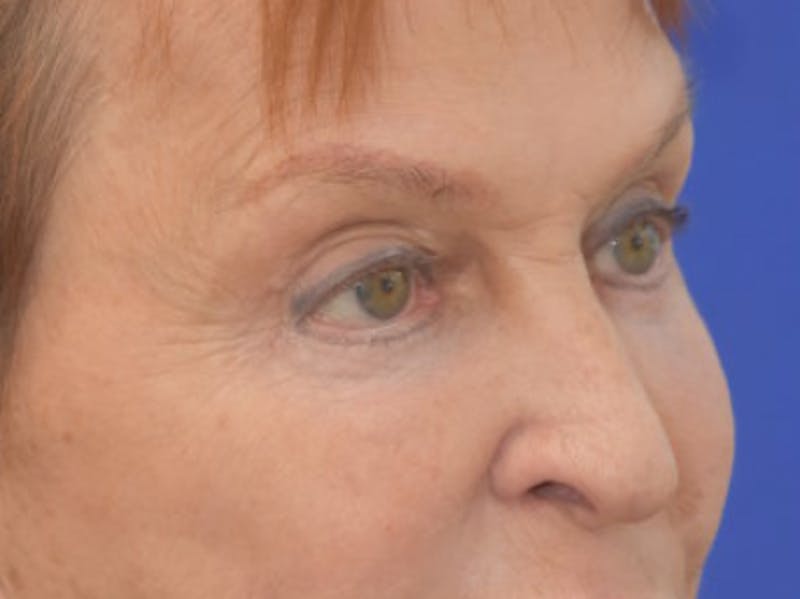 Blepharoplasty Before & After Gallery - Patient 178587 - Image 8