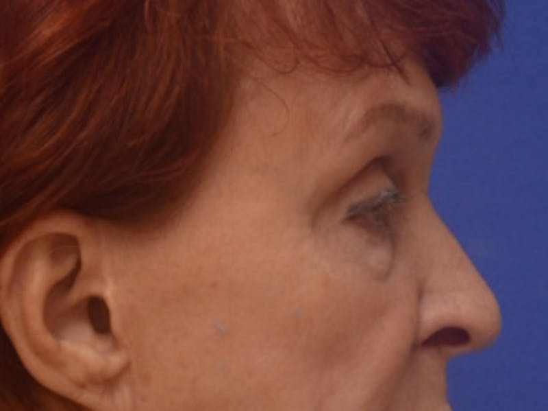 Blepharoplasty Before & After Gallery - Patient 178587 - Image 9