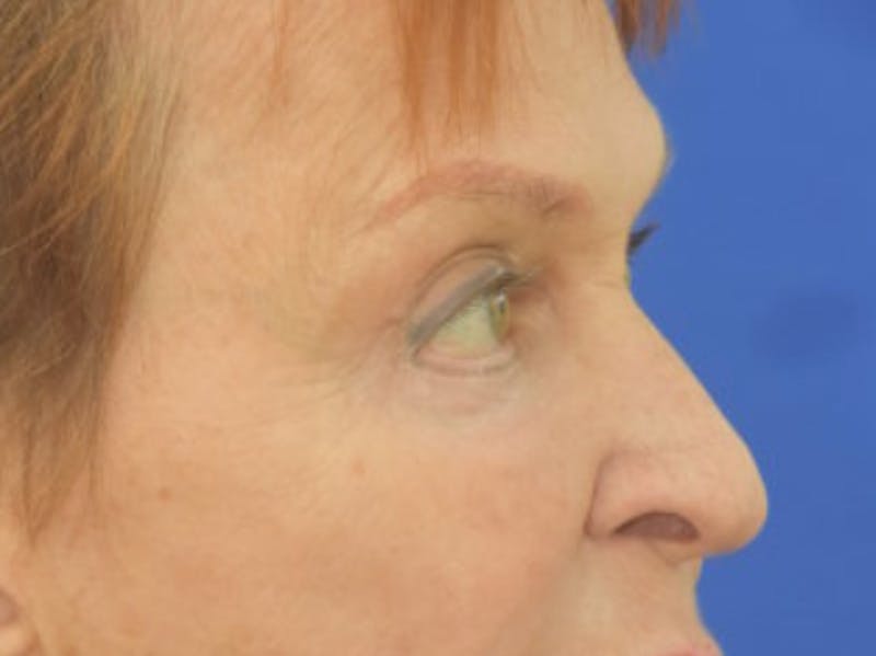 Blepharoplasty Before & After Gallery - Patient 178587 - Image 10
