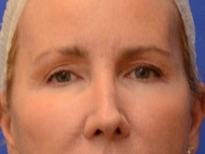 Blepharoplasty Before & After Gallery - Patient 360769 - Image 1