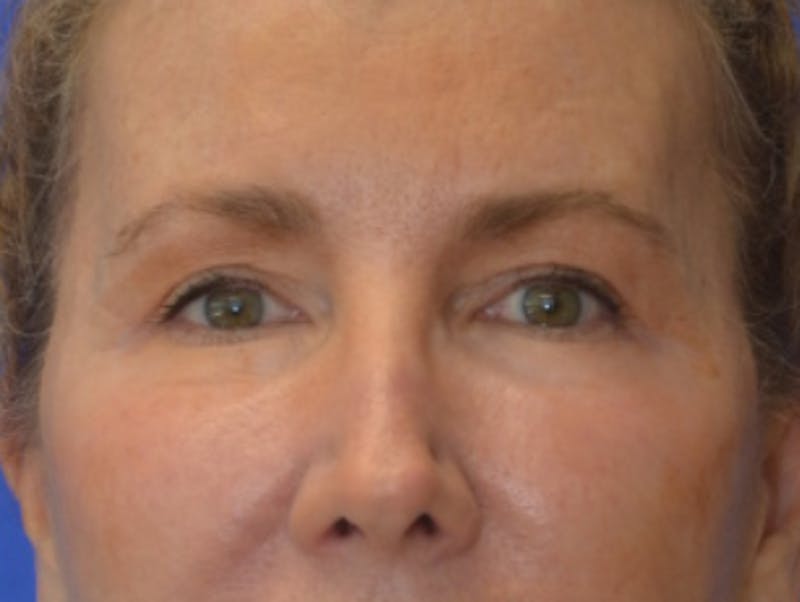 Blepharoplasty Before & After Gallery - Patient 360769 - Image 2