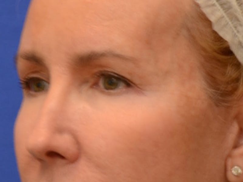 Blepharoplasty Before & After Gallery - Patient 360769 - Image 3
