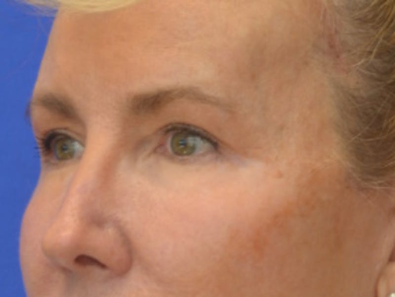 Blepharoplasty Before & After Gallery - Patient 360769 - Image 4