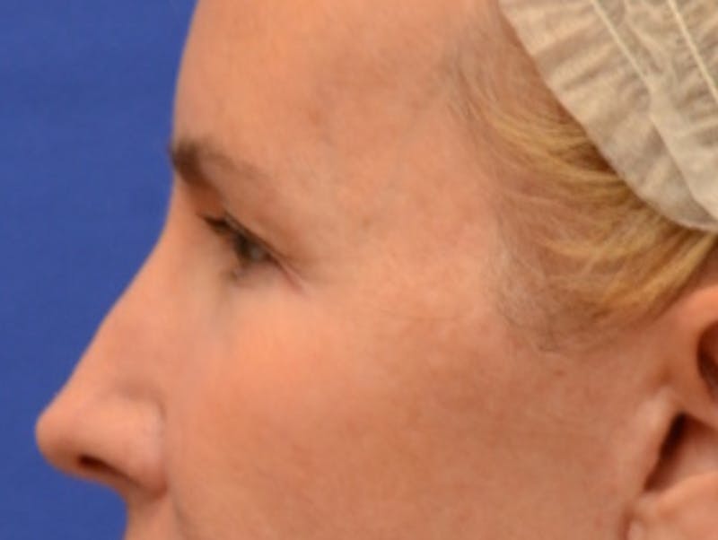 Blepharoplasty Before & After Gallery - Patient 360769 - Image 5