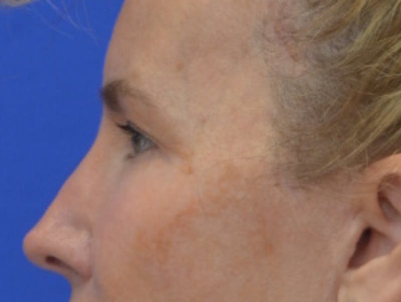 Blepharoplasty Before & After Gallery - Patient 360769 - Image 6