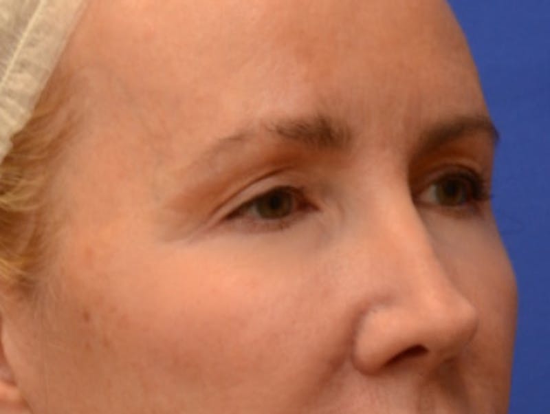 Blepharoplasty Before & After Gallery - Patient 360769 - Image 7