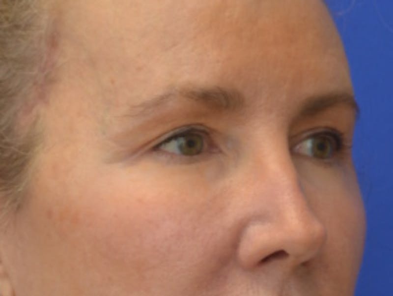 Blepharoplasty Before & After Gallery - Patient 360769 - Image 8