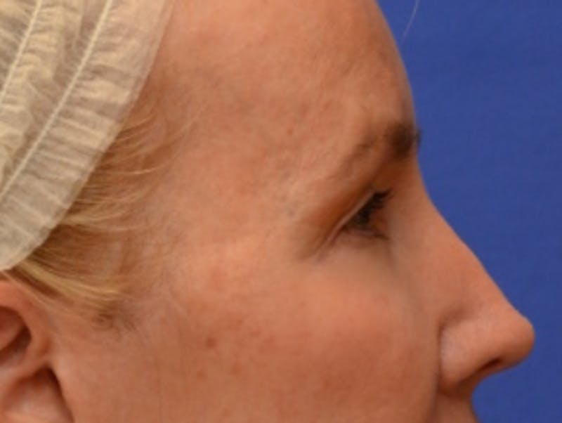 Blepharoplasty Before & After Gallery - Patient 360769 - Image 9