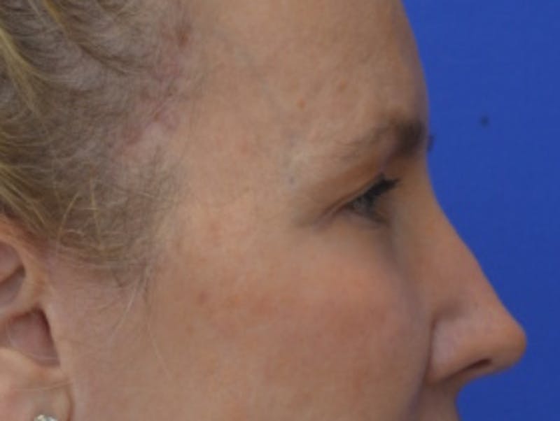 Blepharoplasty Before & After Gallery - Patient 360769 - Image 10