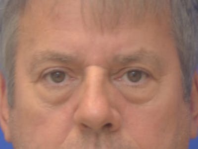 Blepharoplasty Before & After Gallery - Patient 184382 - Image 1
