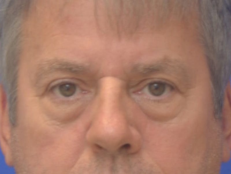 Blepharoplasty Before & After Gallery - Patient 184382 - Image 1
