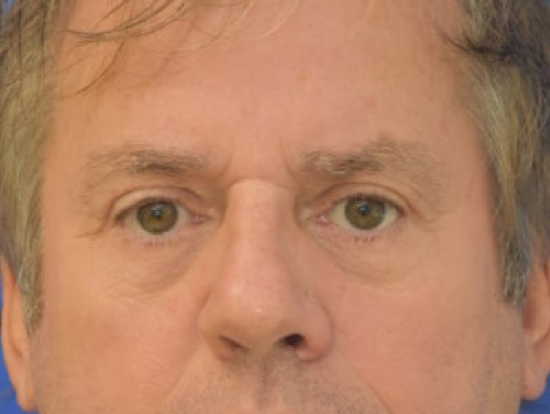 Blepharoplasty Before & After Gallery - Patient 184382 - Image 2