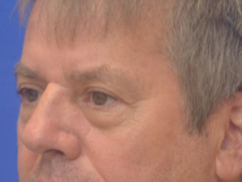 Blepharoplasty Before & After Gallery - Patient 184382 - Image 3