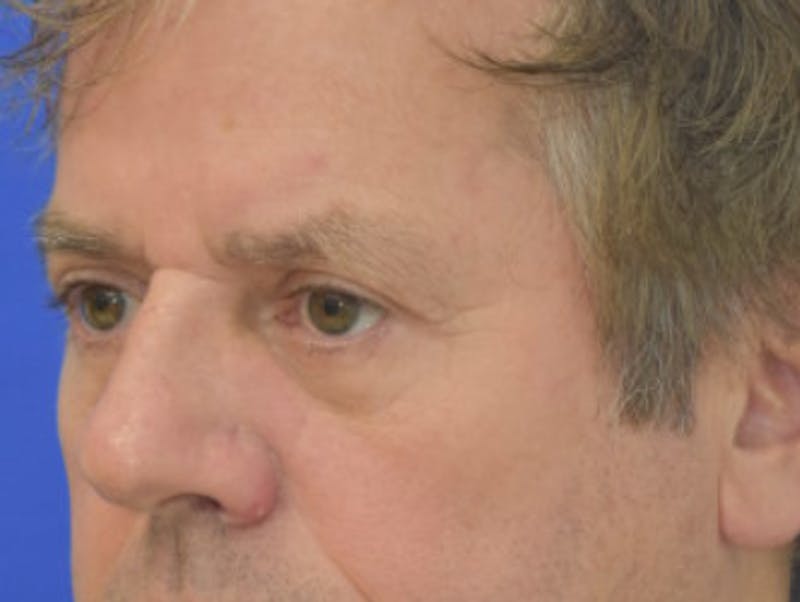 Blepharoplasty Before & After Gallery - Patient 184382 - Image 4