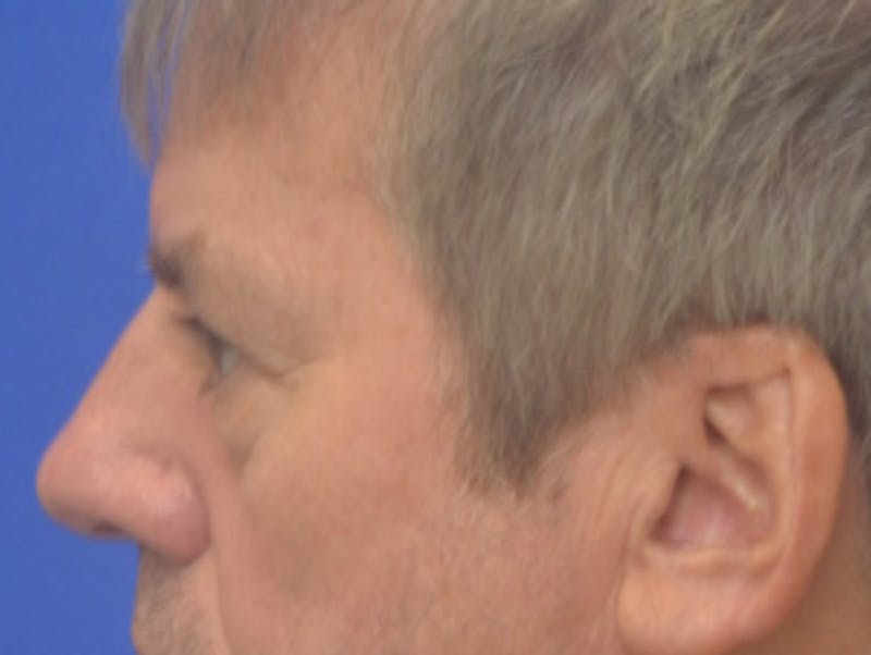 Blepharoplasty Before & After Gallery - Patient 184382 - Image 5