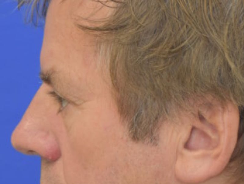 Blepharoplasty Before & After Gallery - Patient 184382 - Image 6
